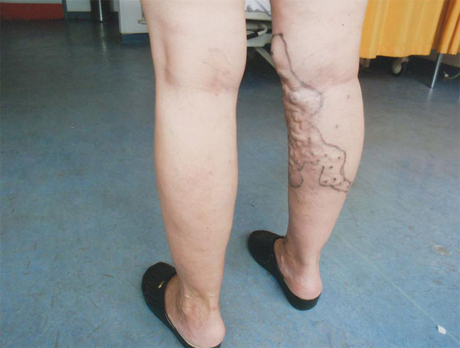 Κιρσοί ποδιών - Αριστερό πόδι Χειρουργημένο - Δεξί πόδι προς Χειρουργείο